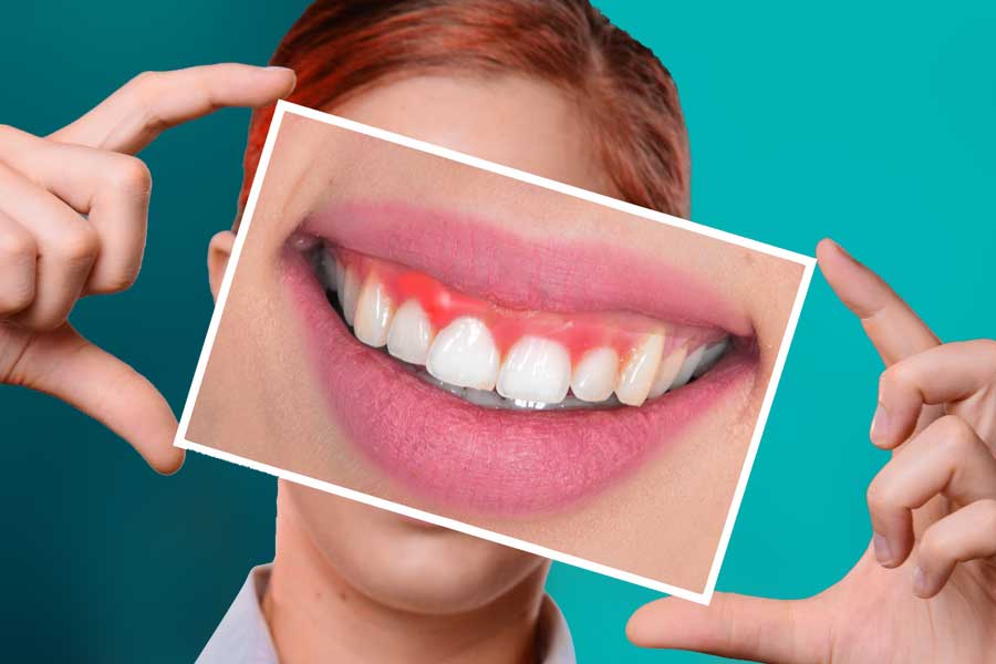 İnovadent Ortodonti Diş Eti Neden Şişer? Şişmesi Nasıl Geçer?